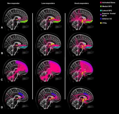 Connectivity in deep brain stimulation for self-injurious behavior: multiple targets for a common network?